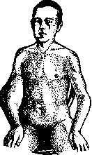 Arthropathy: figure 2 from the 1928–1936 encyclopedia article