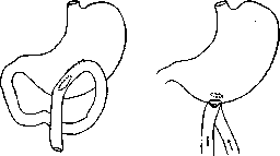 Gastroenterostomy: figure 4 from the 1928–1936 encyclopedia article