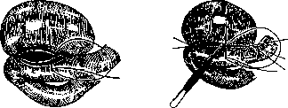Gastroenterostomy: figure 3 from the 1928–1936 encyclopedia article