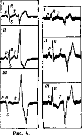 Extrasystole: figure 2 from the 1928–1936 encyclopedia article