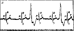 Extrasystole: figure 3 from the 1928–1936 encyclopedia article