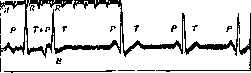 Extrasystole: figure 1 from the 1928–1936 encyclopedia article