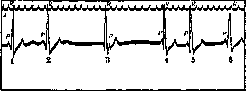 Extrasystole: figure 5 from the 1928–1936 encyclopedia article