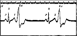 Extrasystole: figure 4 from the 1928–1936 encyclopedia article