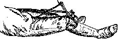 Gonitis: figure 7 from the 1928–1936 encyclopedia article