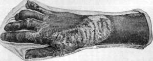 Tuberculous Skin Diseases: figure 6 from the 1928–1936 encyclopedia article