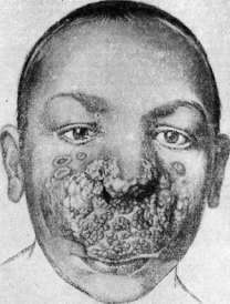 Tuberculous Skin Diseases: figure 2 from the 1928–1936 encyclopedia article