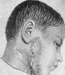 Tuberculous Skin Diseases: figure 1 from the 1928–1936 encyclopedia article