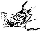 Palpation: figure 5 from the 1928–1936 encyclopedia article