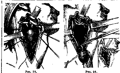 Common Carotid Artery: figure 4 from the 1928–1936 encyclopedia article