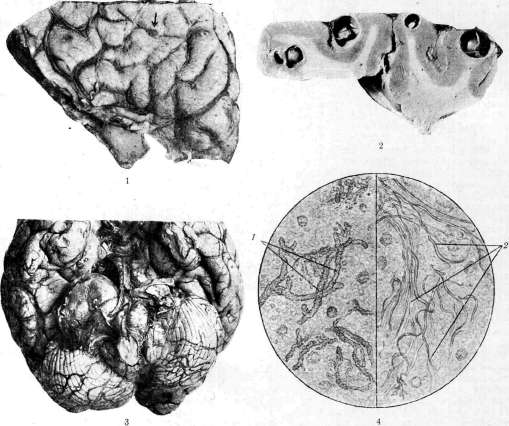 Myelitis: figure 3 from the 1928–1936 encyclopedia article