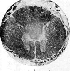 Myelitis: figure 4 from the 1928–1936 encyclopedia article