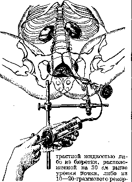 Pyelography: figure 1 from the 1928–1936 encyclopedia article