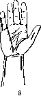 Panaritium: figure 7 from the 1928–1936 encyclopedia article