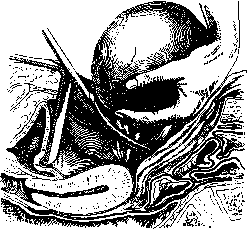 Ovariotomy: figure 4 from the 1928–1936 encyclopedia article