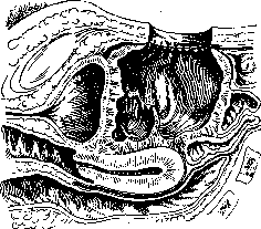 Ovariotomy: figure 8 from the 1928–1936 encyclopedia article