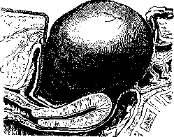 Ovariotomy: figure 5 from the 1928–1936 encyclopedia article