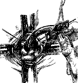 Tracheotomy: figure 5 from the 1928–1936 encyclopedia article
