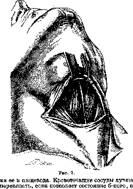 Tracheotomy: figure 2 from the 1928–1936 encyclopedia article