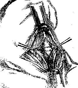 Tracheotomy: figure 3 from the 1928–1936 encyclopedia article