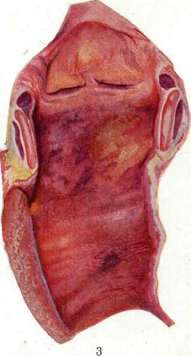 Influenza: figure 12 from the 1928–1936 encyclopedia article