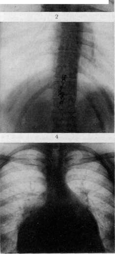 Myelography: figure 2 from the 1928–1936 encyclopedia article