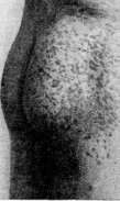 Dermographism: figure 4 from the 1928–1936 encyclopedia article