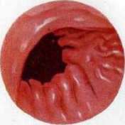 Gastroscopy: figure 5 from the 1928–1936 encyclopedia article