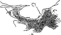 Acromegaly: figure 4 from the 1928–1936 encyclopedia article