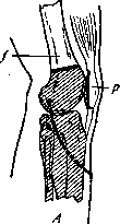 Gritti's Amputation: figure 1 from the 1928–1936 encyclopedia article
