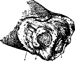 Gritti's Amputation: figure 3 from the 1928–1936 encyclopedia article