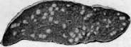 Pulmonary Tuberculosis: figure 5 from the 1928–1936 encyclopedia article