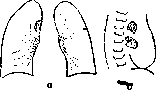 Pulmonary Tuberculosis: figure 14 from the 1928–1936 encyclopedia article