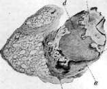 Pulmonary Tuberculosis: figure 1 from the 1928–1936 encyclopedia article
