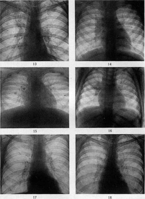Pulmonary Tuberculosis: figure 18 from the 1928–1936 encyclopedia article