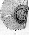 Pulmonary Tuberculosis: figure 2 from the 1928–1936 encyclopedia article
