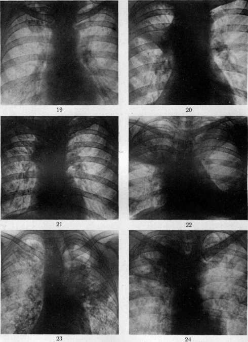 Pulmonary Tuberculosis: figure 19 from the 1928–1936 encyclopedia article
