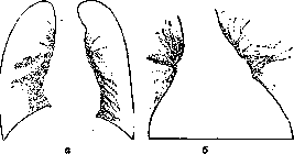Pulmonary Tuberculosis: figure 15 from the 1928–1936 encyclopedia article