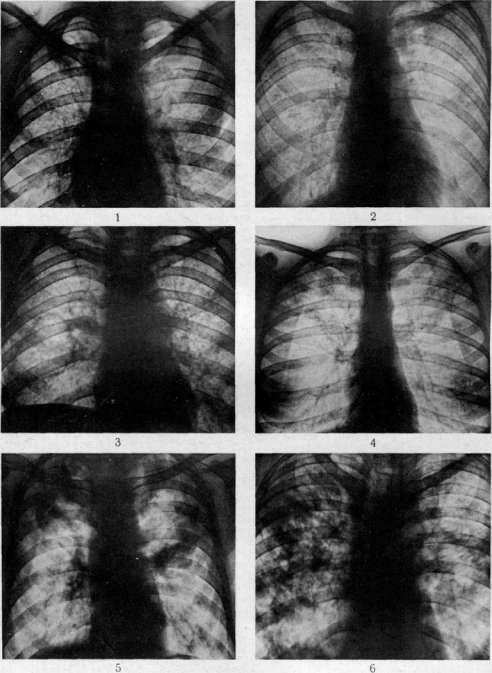 Pulmonary Tuberculosis: figure 16 from the 1928–1936 encyclopedia article