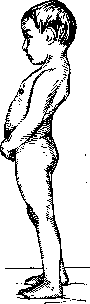 Lordosis: figure 11 from the 1928–1936 encyclopedia article
