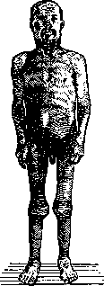 Beck's Disease: figure 1 from the 1928–1936 encyclopedia article