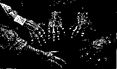 Beck's Disease: figure 2 from the 1928–1936 encyclopedia article
