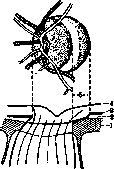 Distraction Sickle: figure 1 from the 1928–1936 encyclopedia article
