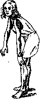 Dystrophy: figure 4 from the 1928–1936 encyclopedia article