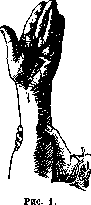 Hyperkinesis: figure 1 from the 1928–1936 encyclopedia article