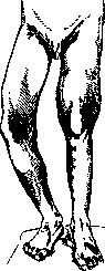 Fibrous Osteitis: figure 1 from the 1928–1936 encyclopedia article