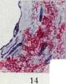 Tuberculosis: figure 2 from the 1928–1936 encyclopedia article