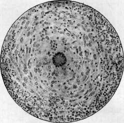 Tuberculosis: figure 5 from the 1928–1936 encyclopedia article