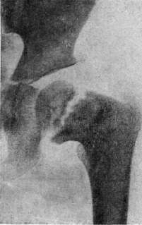 Tuberculosis: figure 9 from the 1928–1936 encyclopedia article
