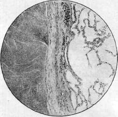 Tuberculosis: figure 6 from the 1928–1936 encyclopedia article